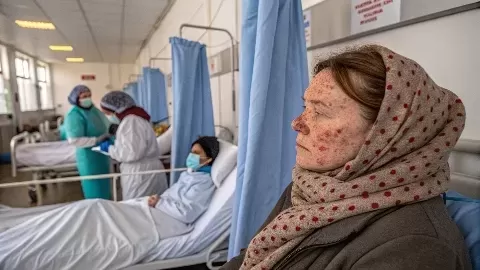 Spotting Measles Symptoms and Recommended Actions to Take